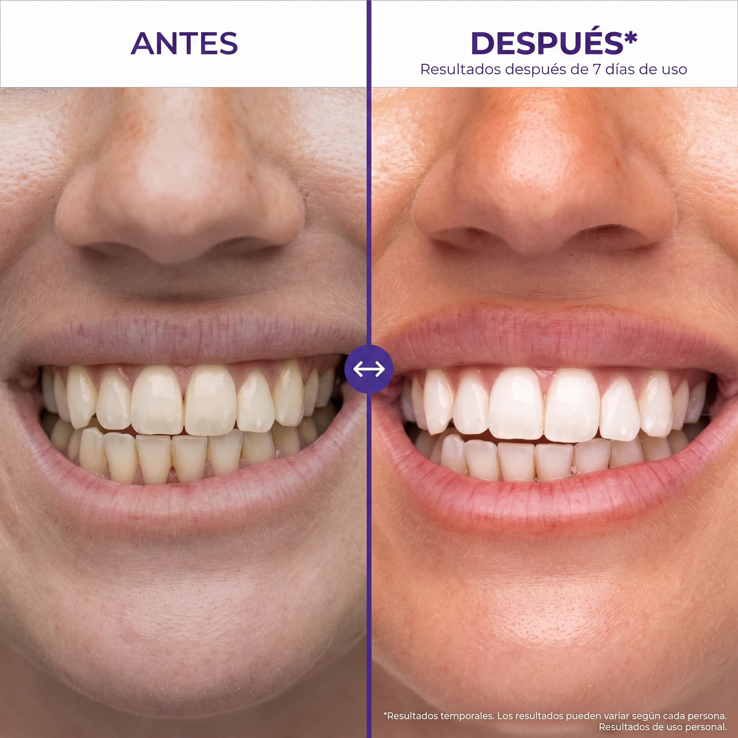 Hismile® Tiras Blanqueadoras Dentales