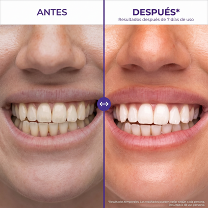 Hismile® Tiras Blanqueadoras Dentales